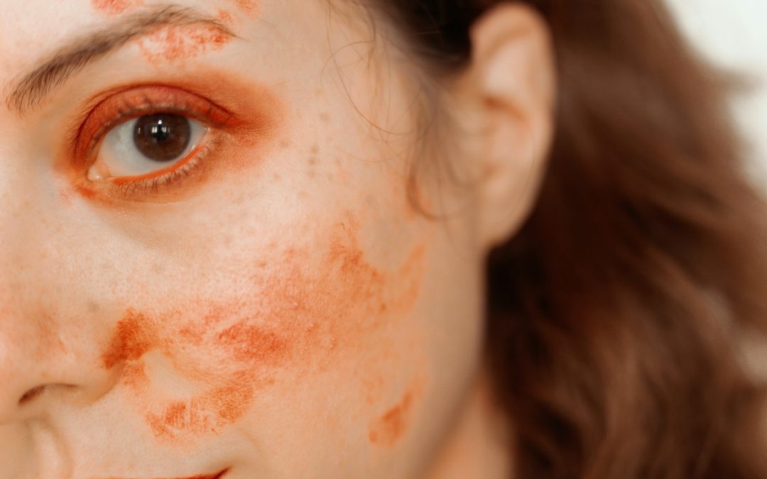 Eczema Flare-Ups in Summer: How to Support Your Skin and Comfort
