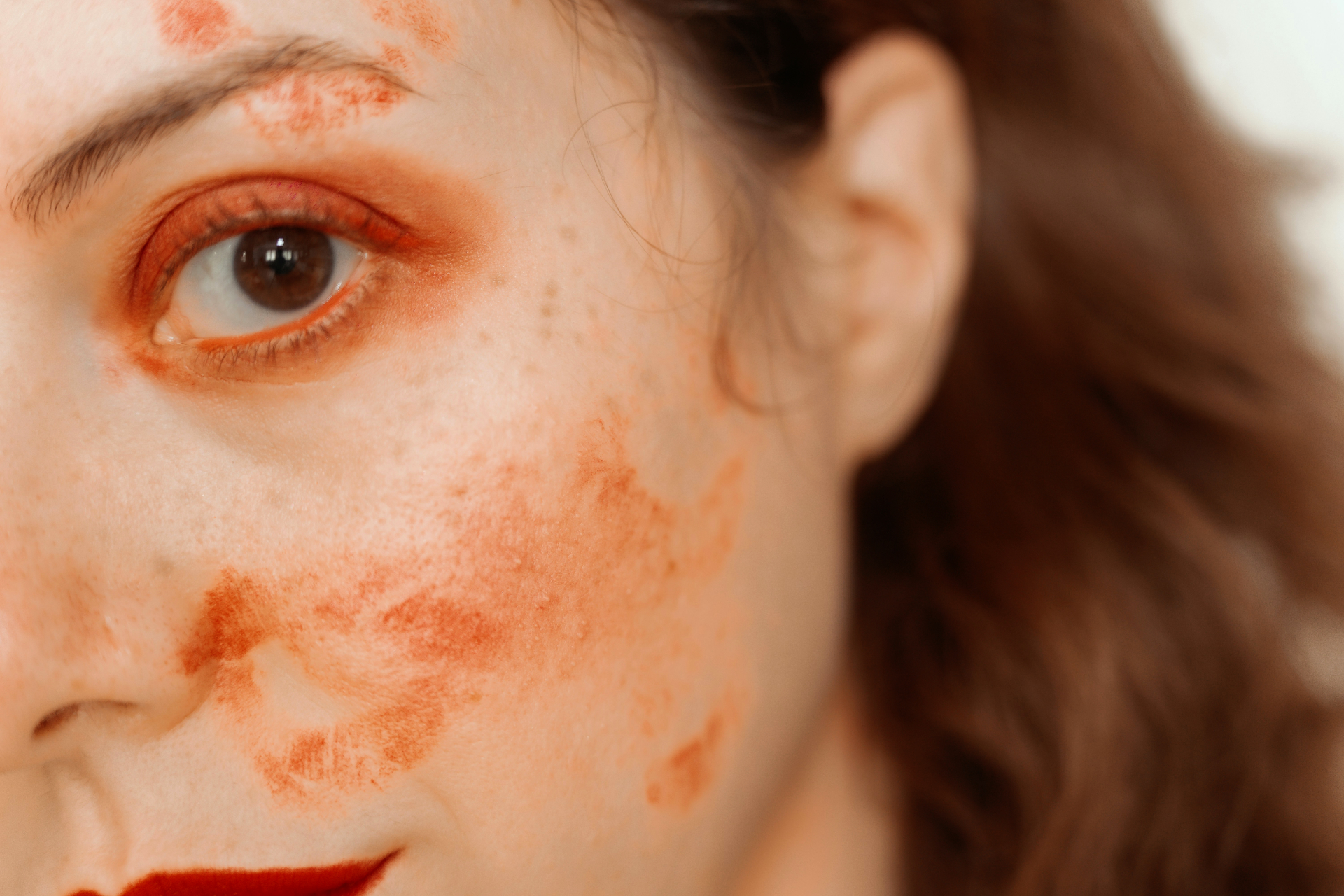 eczema Eczema on a ladies face